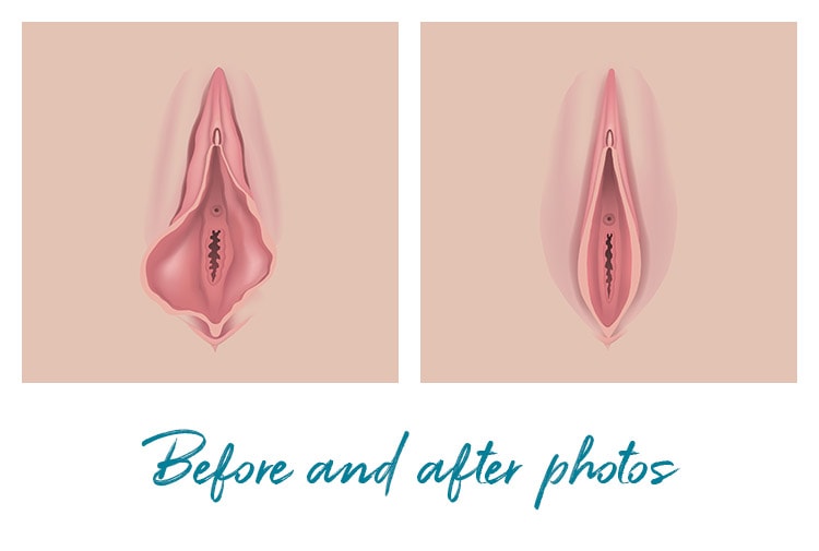 Vaginal Rejuvenation procedures before and after photos New Jersey